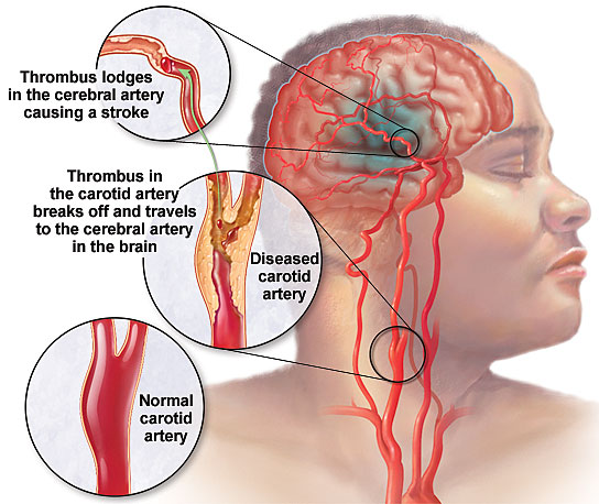 Stroke / Paralysis Image